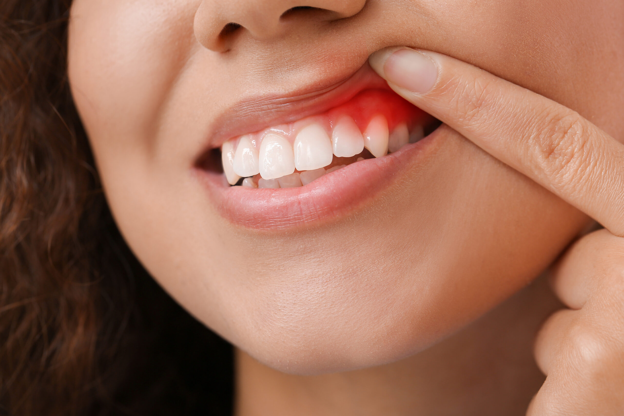 Periodontal Gum Disease Treatment