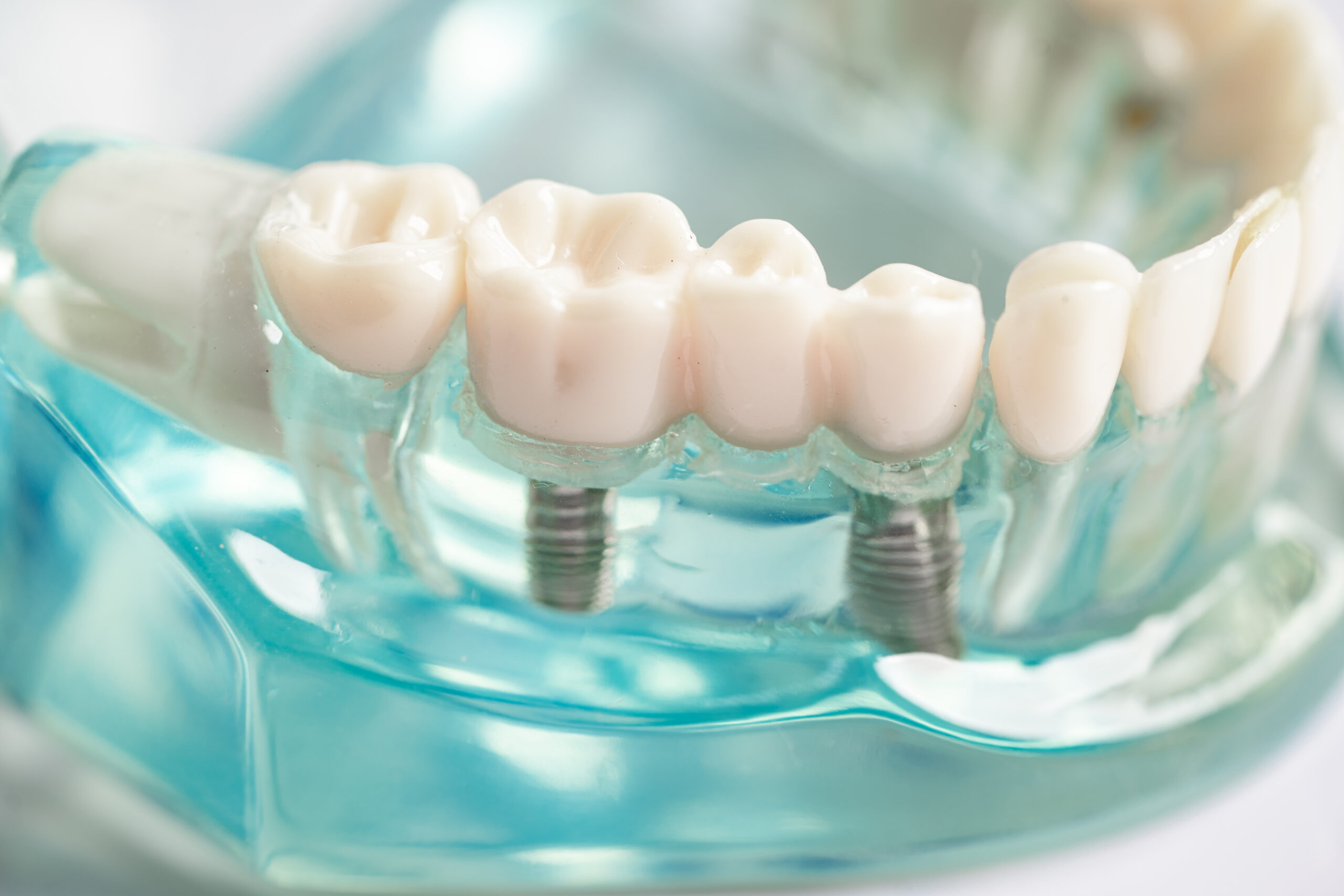 Dental Implants and Restorations